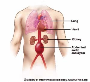 imagini anevrismul aortic abdominal